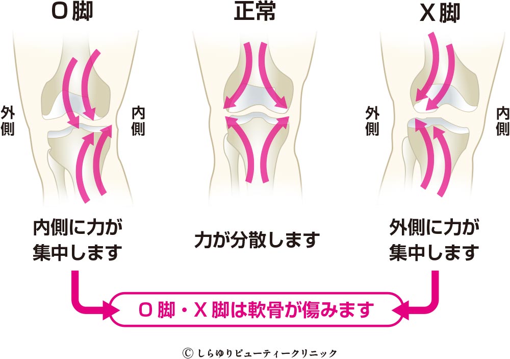 O脚X脚治療〜しらゆりビューティークリニック